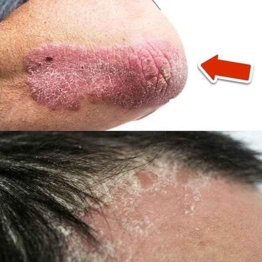 This vitamin removes psoriasis forever