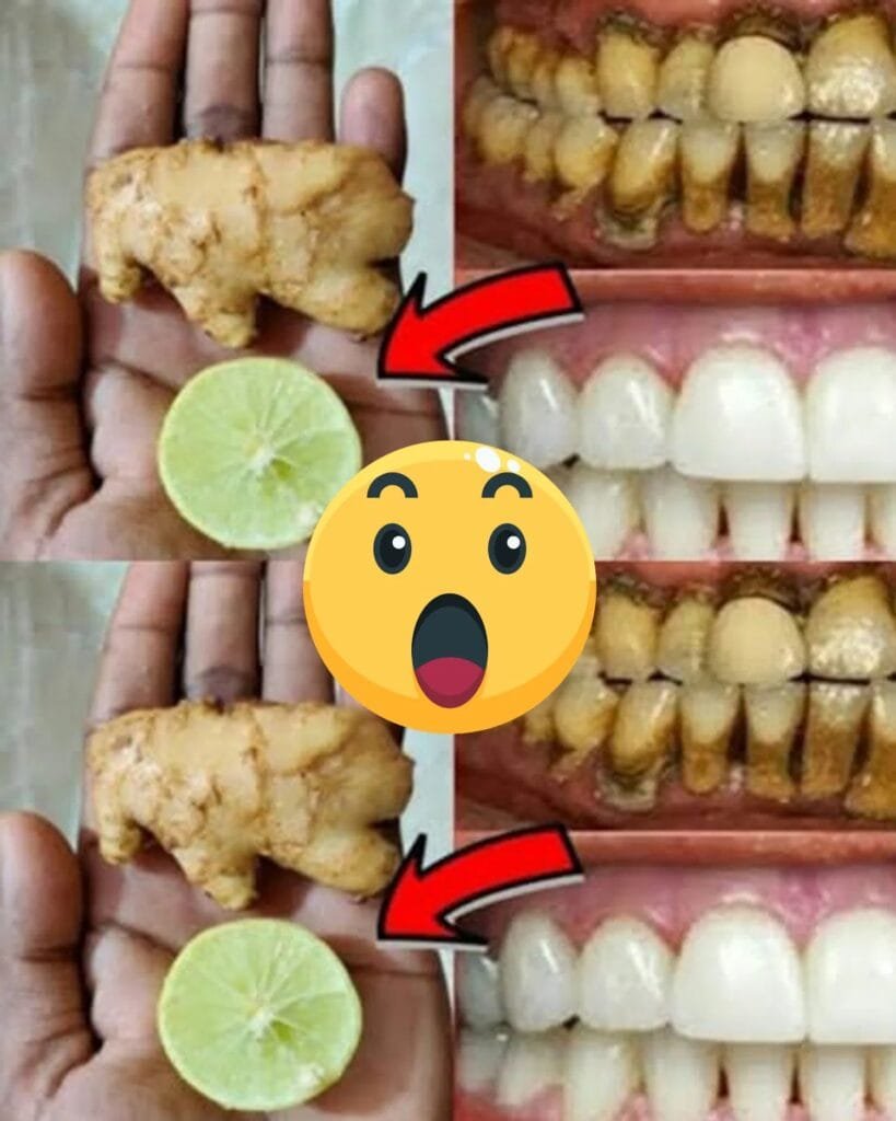 This Recipe Will Turn Yellow Teeth White Like Pearls!  Ginger & Lime Teeth Whitening Hack