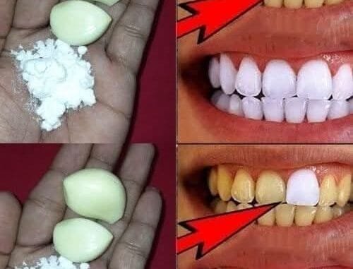 Why Garlic Is Most Important for Teeth Whitening