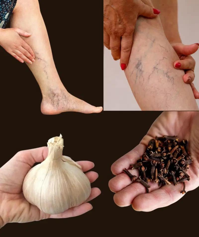 Leg Pain, Rheumatism, Varicose Veins, Arthritis – Natural Remedy with Cloves & Garlic!