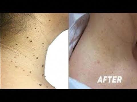 How to Remove Skin Tags and Warts Overnight: Safe and Effective Methods