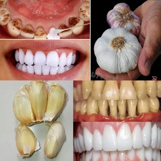 Improve Your Oral Health Naturally with Garlic
