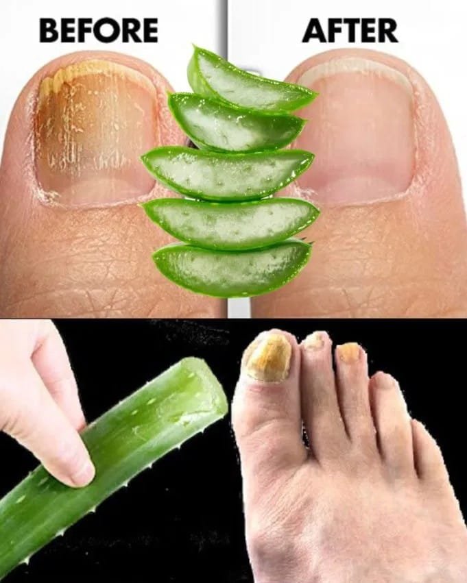 Removes Nail Fungus Instantly! The Best Aloe Vera Remedy