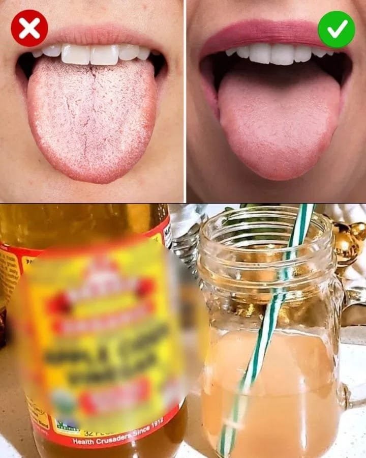 Do This Before Bed: The Overnight Remedy to Combat Candida and Fungi