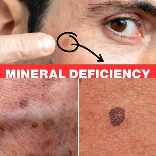 Lack of This Mineral Is Causing Your Age Spots: The Importance of Seleniu