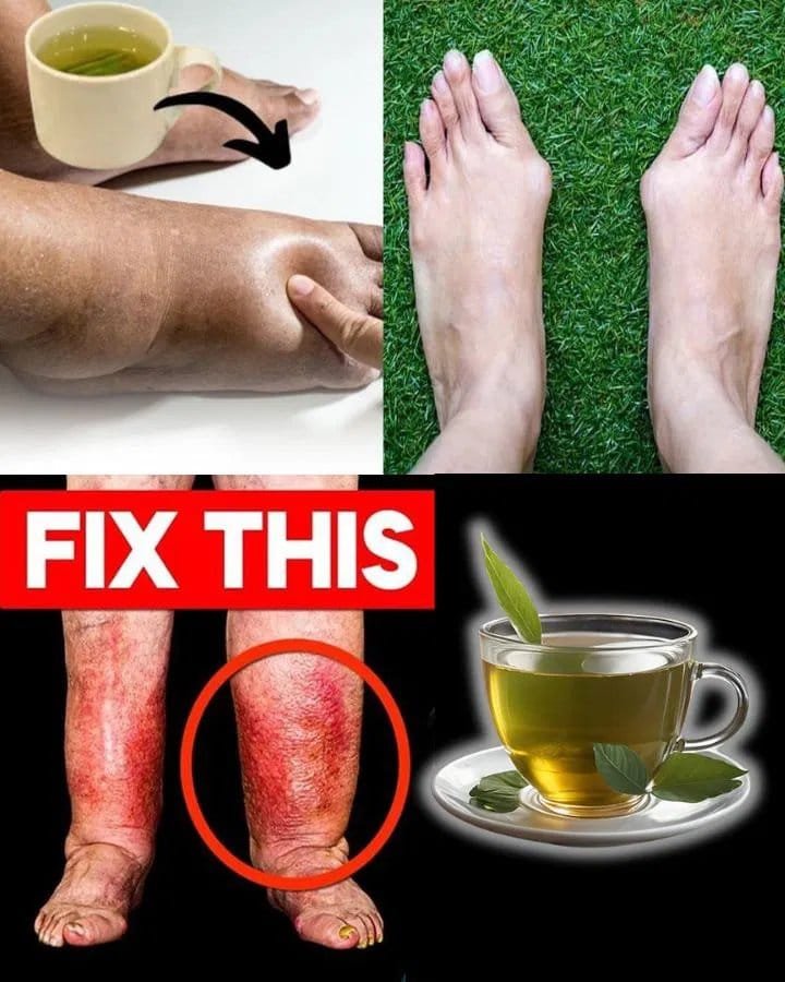 Natural Relief for Swollen Legs: A Powerful Herbal Tea Remedy for Fluid Retention