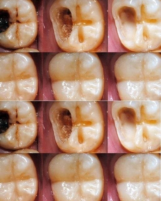 How to Naturally Repair a Cavity: Tips to Keep Your Teeth Strong & Avoid the Dentist