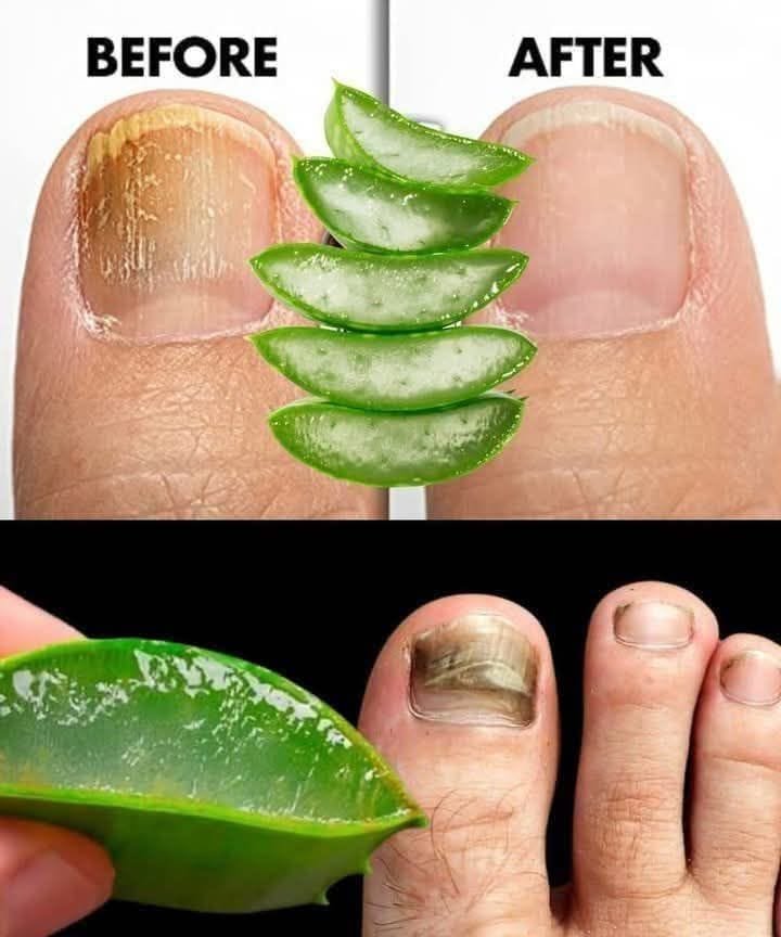 Natural Remedy for Nail Fungus: Effective Treatment for Quick Relief