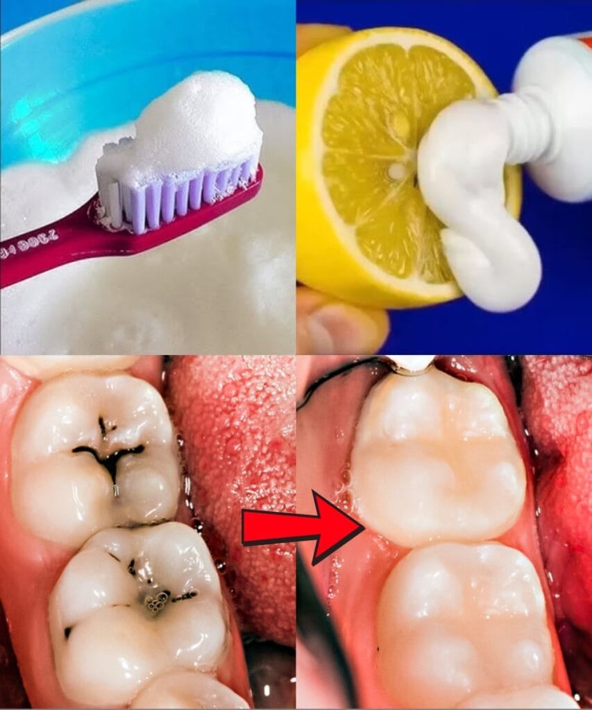 How to Naturally Repair a Cavity and Strengthen Your Teeth